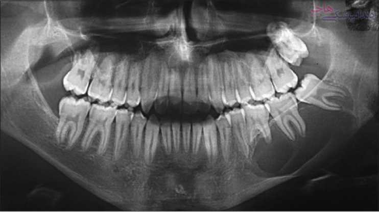 odontogenic keratocyst treatment